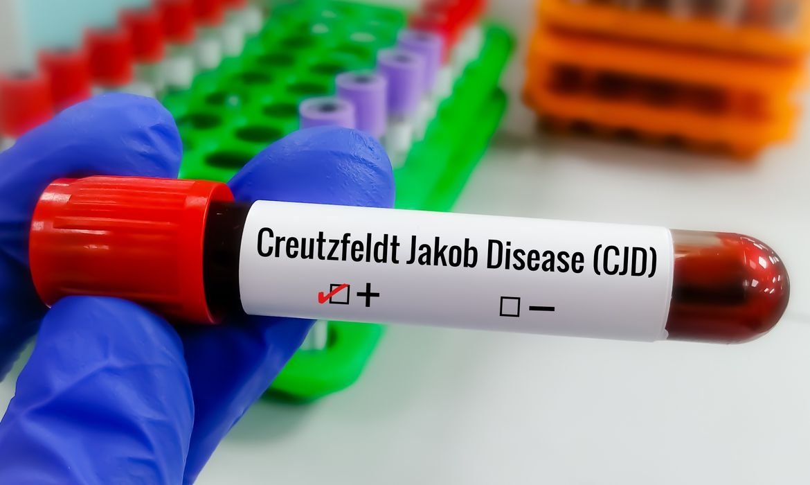 Tipos de Creutzfeldt-Jakob: conheça as formas da doença