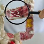Incidência de doença intestinal quintuplica em 13 anos