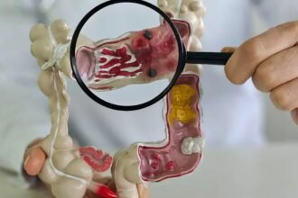 Incidência de doença intestinal quintuplica em 13 anos