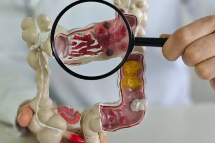 Incidência de doença intestinal quintuplica em 13 anos