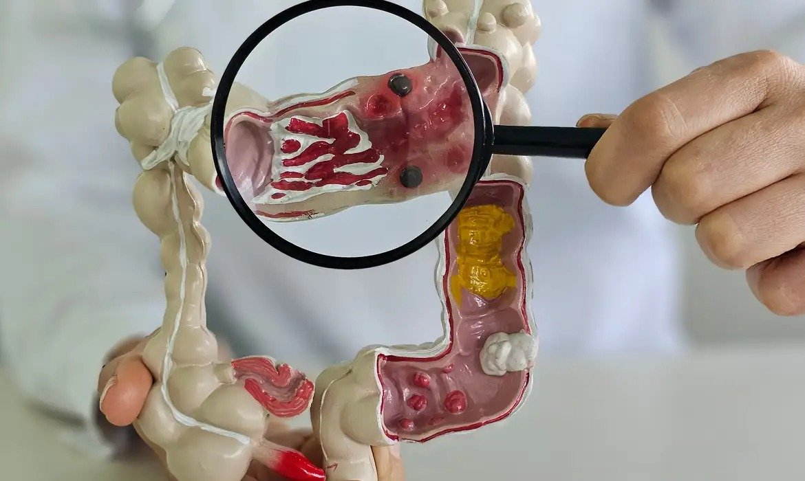 Incidência de doença intestinal quintuplica em 13 anos